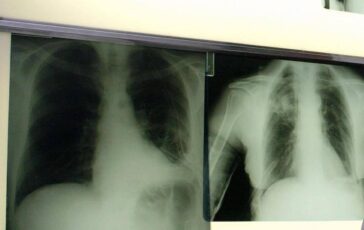 Cancro polmone con nuova combinazione malattia sotto controllo piu a lungo 364x230