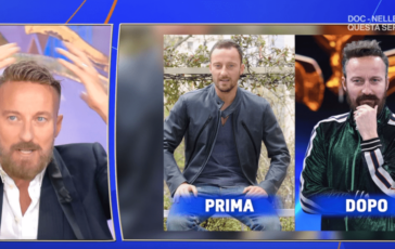 Francesco Facchinetti la battaglia contro la calvizie Ho trovato la pace con una patch cutanea 364x230