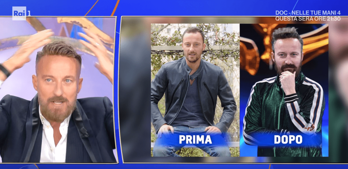 Francesco Facchinetti, la battaglia contro la calvizie: "Ho trovato la pace con una patch cutanea"