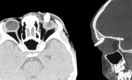 Ha un gonfiore sotto locchio in ospedale scoprono che ha un dente nella palpebra lo strano caso in India 265x160