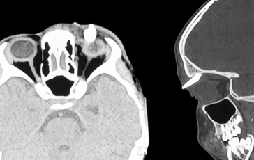 ha un gonfiore sotto locchio in ospedale scoprono che ha un dente nella palpebra lo strano caso in india 2