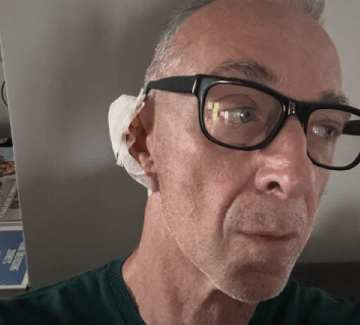 Linus ha una malattia della pelle: "Si chiama Epitelioma". Di cosa si tratta