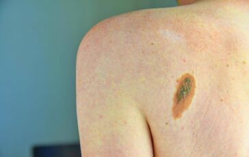 Melanoma: Cancer's Mutational Signature Could Change Treatment 364x230