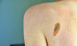 Melanoma la firma mutazionale del cancro potra cambiare la cura﻿ 265x160