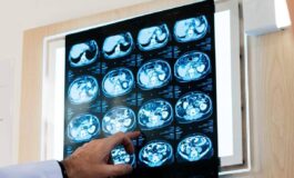 Nodulo polmonare che cose come si diagnostica e quando intervenire 265x160