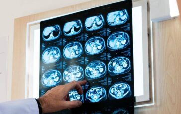 Nodulo polmonare che cose come si diagnostica e quando intervenire 364x230