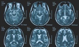 Una persona su 3 ha un disturbo neurologico a Napoli arriva BrainSpace House 265x160