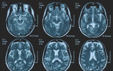 Una persona su 3 ha un disturbo neurologico a Napoli arriva BrainSpace House 364x230