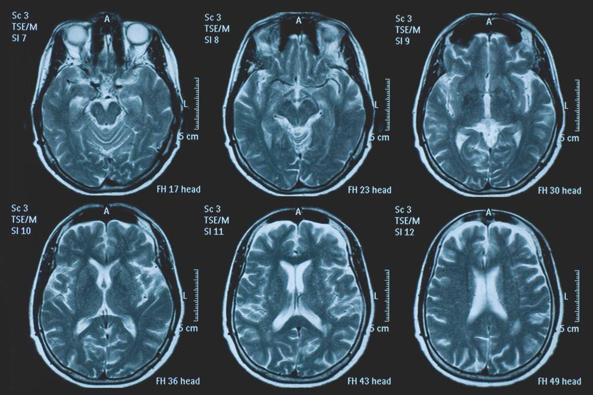 Una persona su 3 ha un disturbo neurologico, a Napoli arriva BrainSpace House