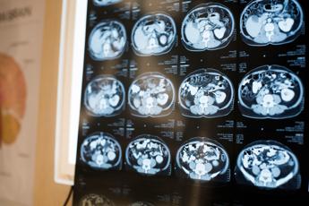 alzheimer scoperto in italia nuovo gene che provoca malattia lo studio 2