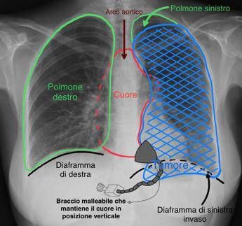 tumore gli comprimeva cuore e polmone salvato con complesso intervento alle molinette 2