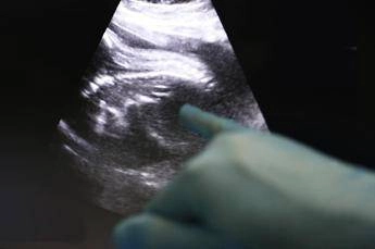 Trapianti, Uk, Amy prima bimba nata da donazione di utero da vivente