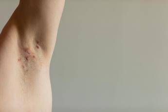 Idrosadenite suppurativa, appello esperti ‘sia inserita nel Piano delle cronicità’