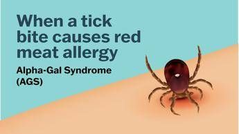 Se una zecca rende allergici a carne e latticini, cos’è la sindrome alfa-gal