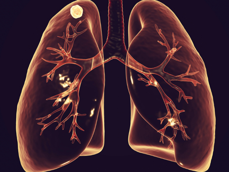 Bronchiolite: cos’è e quali sono i sintomi nei bambini