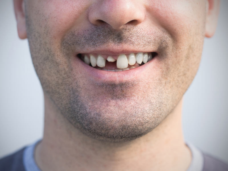 Sognare di rompersi i denti: cosa significa?
