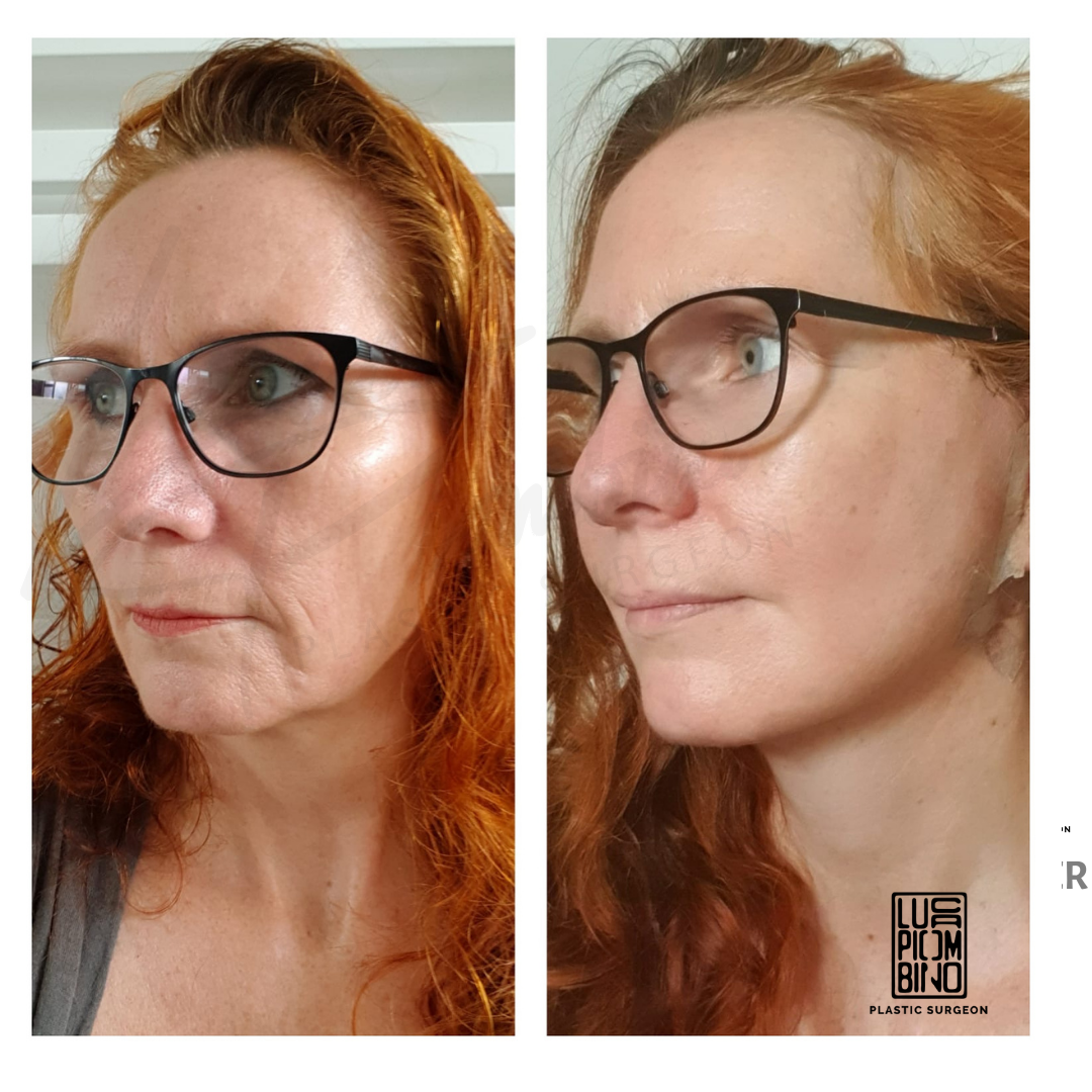 facelift2