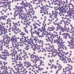 meningite