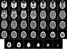 edema cerebrale