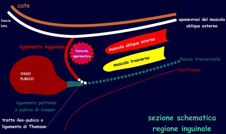 ernia inguinale