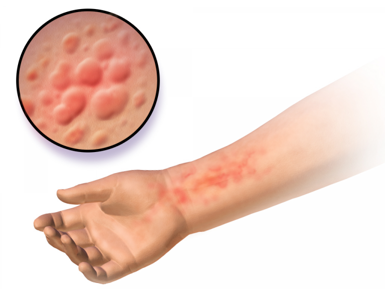 orticaria