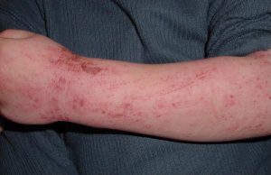 psoriasi