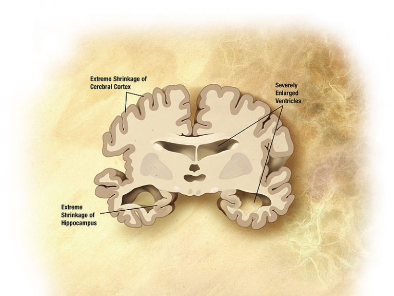 Alzheimer