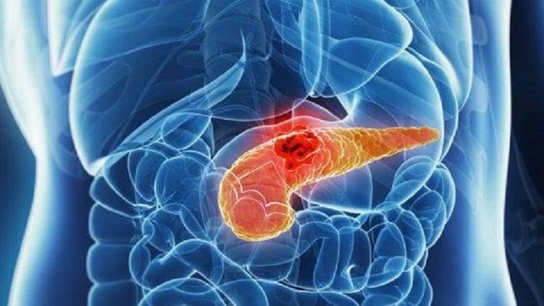 tumore al pancreas