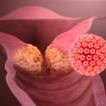 pap test