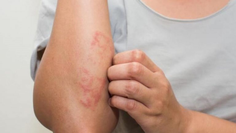 psoriasi