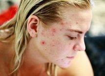 acne cistica
