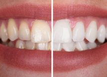 faccette dentali