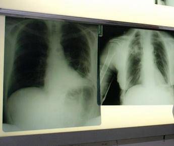 salute esperti virus sinciziale sottovalutato nonostante oltre 50mila ricoveri lanno 2