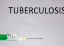 tubercolosi