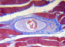 trichinellosi
