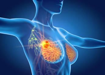 nuovo cancro seno ereditario aiom passo avanti per diagnosi di precisione 2
