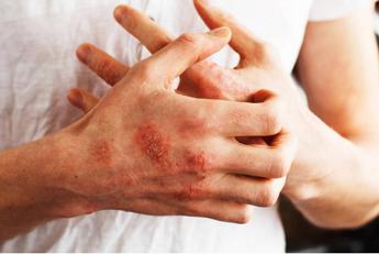 psoriasi a placche studio conferma efficacia terapia orale deucravacitinib 2