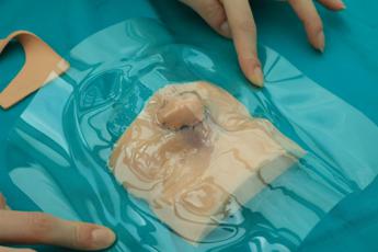 ricostruito il naso a un bambino grazie alla stampa 3d e al suo fratellino 2