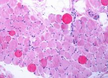 distrofia duchenne via italiana per riparare e rigenerare i muscoli 2