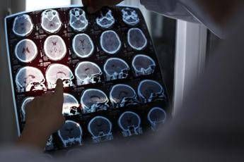 rallentare lalzheimer con il litio scoperta la scintilla che innesca la patologia 2