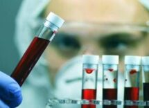 alzheimer sin test del sangue svolta epocale per diagnosi tempestive e cure mirate 2