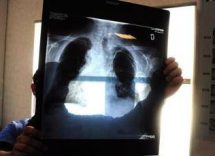 tumori in carcinoma polmonare risultati positivi da combinazione in prima linea 2