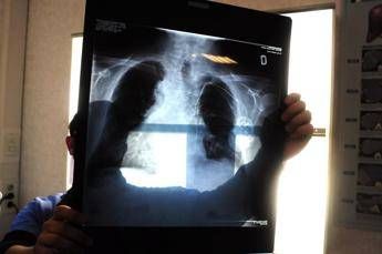 tumore al polmone con terapia mirata piu chemio sopravvivenza globale di quasi 4 anni 2