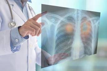 tumori nel 2050 i morti cancro supereranno i 18 milioni 75 lo studio su lancet 2