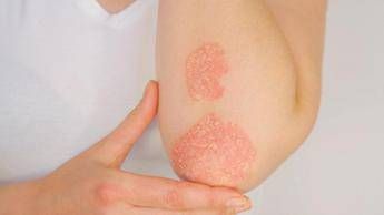 giornata della psoriasi ucb conferma il suo impegno a fianco dei pazienti 2