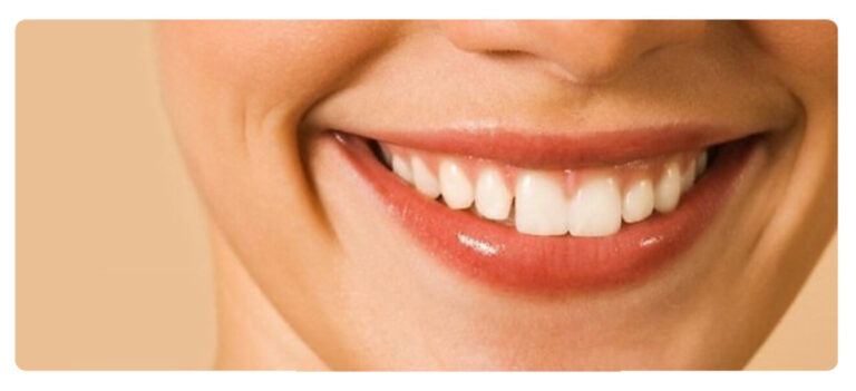 sorriso perfetto 2