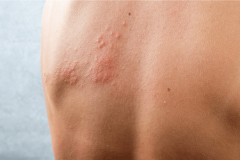 vaccini 1 over 50 su 2 con cronicita non parla col medico di herpes zoster 2