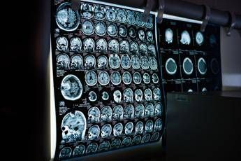 uno spray nasale ferma linvecchiamento del cervello lo studio 2