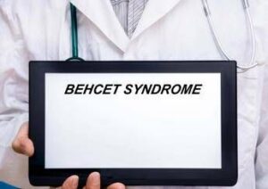 giornata sindrome behcet esperto oggi possiamo prevenire cecita 2
