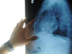 radiologia interventistica ssn e fondazioni per cure piu accessibili 2